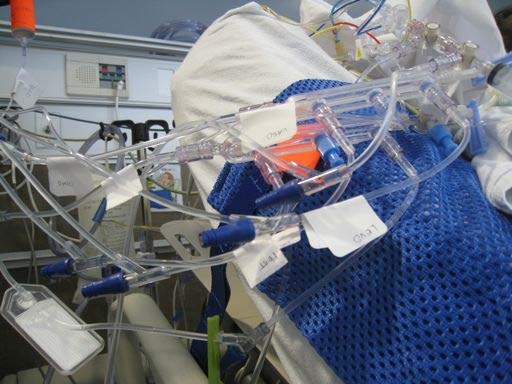 multiple-iv-infusions-slides-004